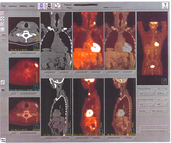 Positron Emission Tomography (PET) image